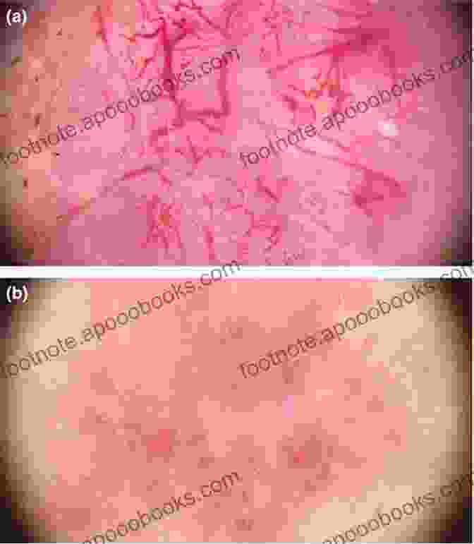 Dermoscopy Image Of Basal Cell Carcinoma Basal Cell Carcinoma: Advances In Treatment And Research