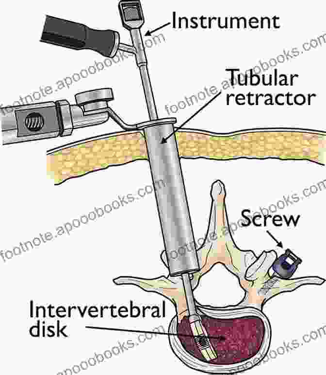 Infographic Showcasing Different Minimally Invasive Spine Surgery Techniques Decision Making For Minimally Invasive Spine Surgery