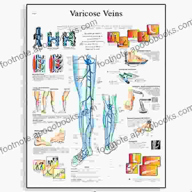 Varicose Veins Chart Full Illustrated Varicose Veins E Chart: Full Illustrated