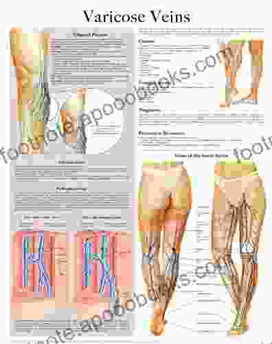 Varicose Veins E Chart: Full Illustrated